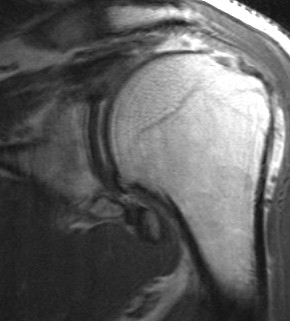 Supraspinatous Tear Retracted to Glenoid T1